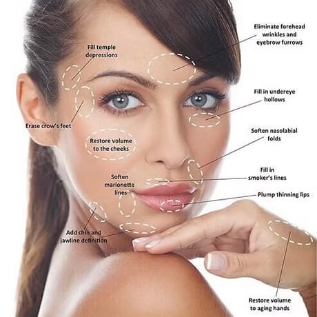Diagram of dermal filler treatment areas across the face, neck and hands