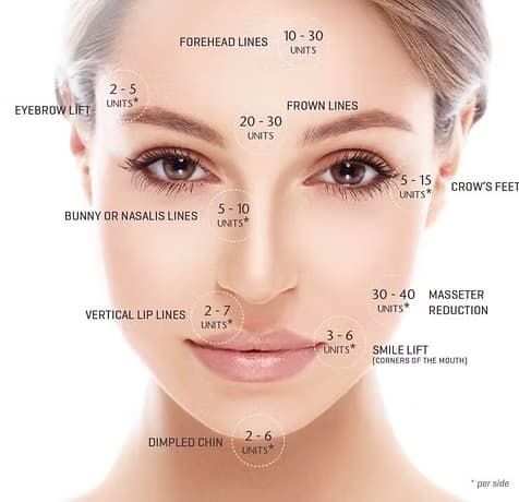 Diagram of typical neurotoxin treatment areas and unit ranges across the face
